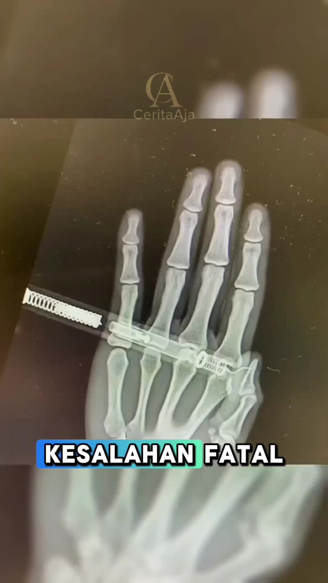 alat medis ini bisa menjadi alat yang sangat berbahaya jika tidak berhati² #faktamenarik #faktaunik 